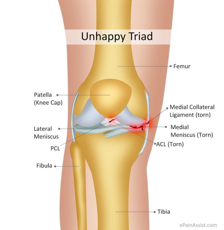 Pes Anserine Bursitis A Pain In The Knee Physiohealth