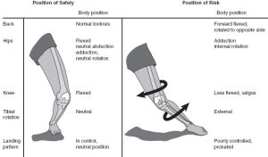 Prehabilitation for ACL Reconstruction | Physiohealth