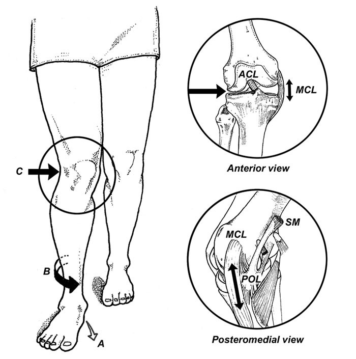 Pes Anserine Bursitis- “A pain in the knee” | Physiohealth