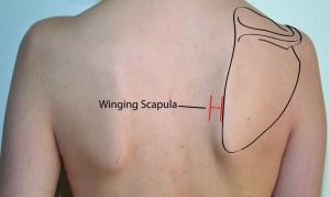 Scapula Dyskinesis and Throwing Athletes : Just Wing it? | Physiohealth